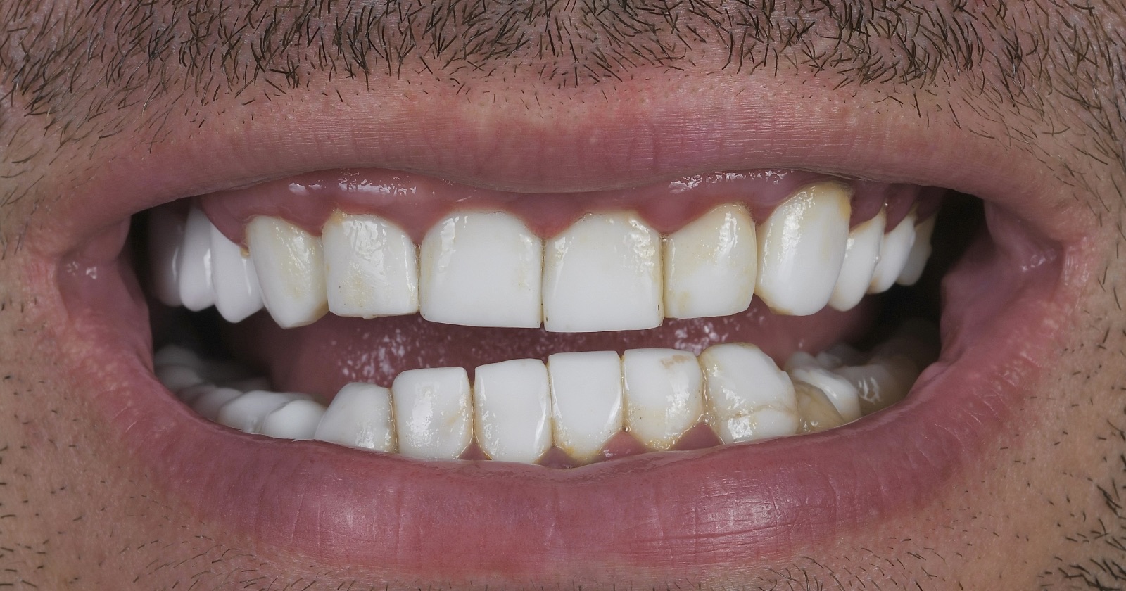 Before treatment