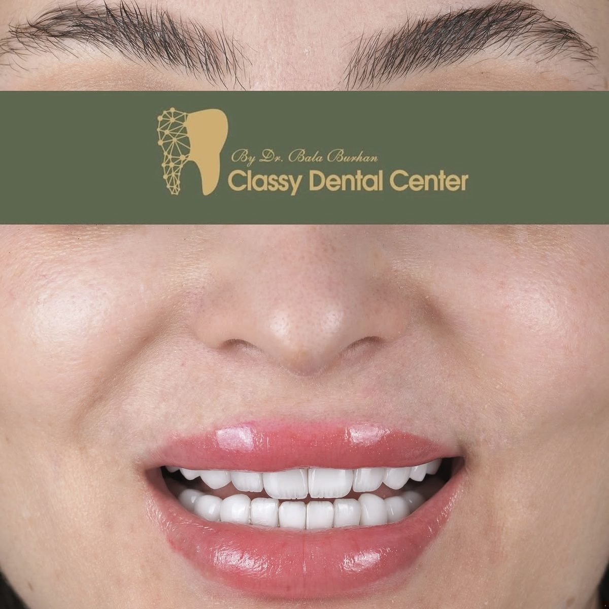 Smile transformation by Classy Dental