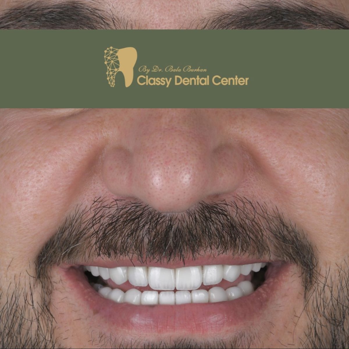 Smile transformation by Classy Dental