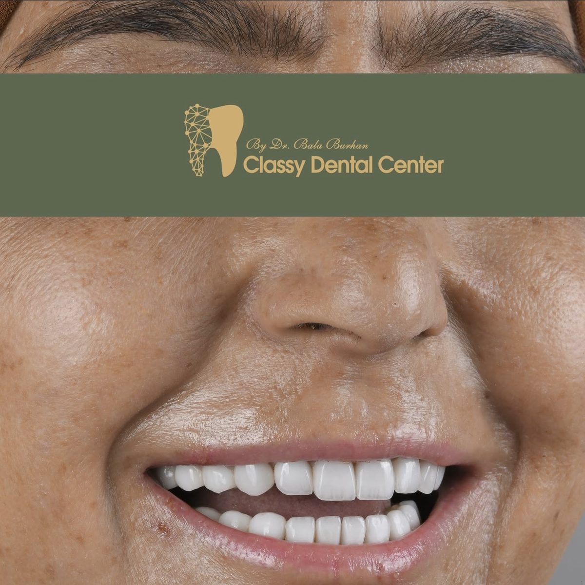 Smile transformation by Classy Dental