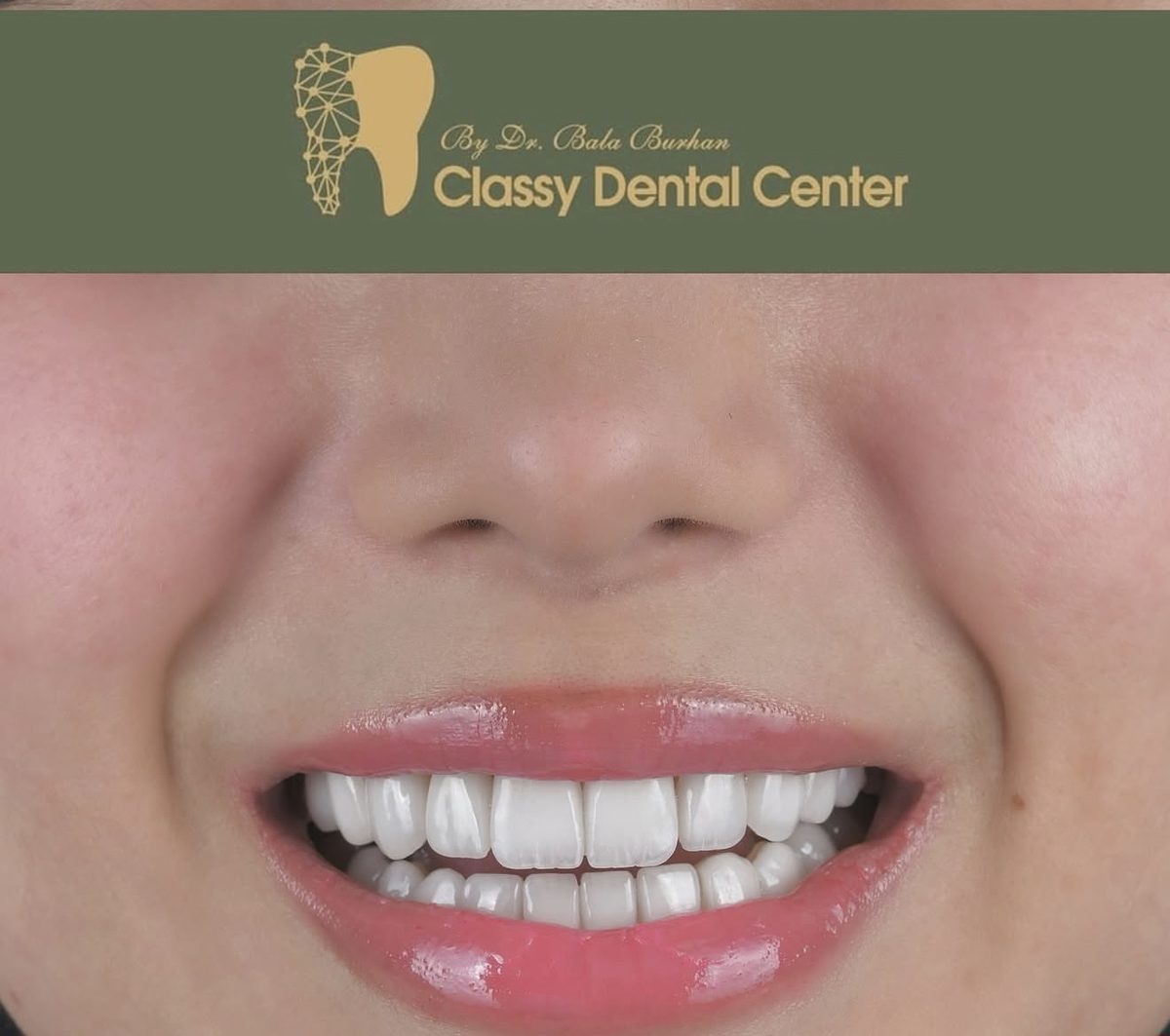 Smile transformation by Classy Dental