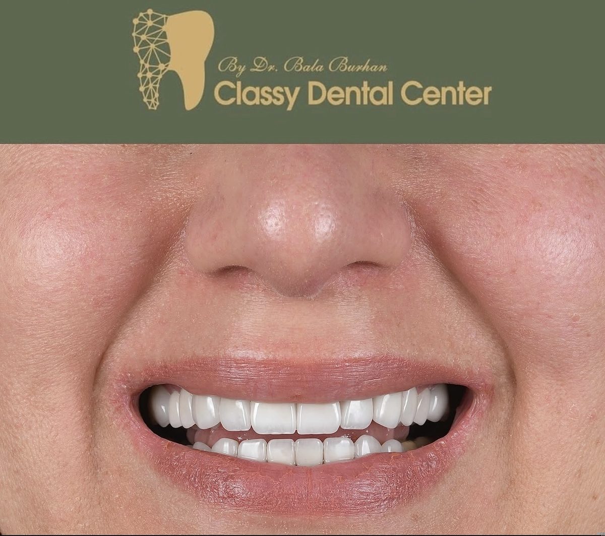 Smile transformation by Classy Dental