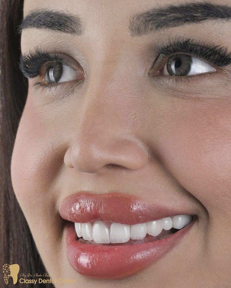 Smile transformation by Classy Dental