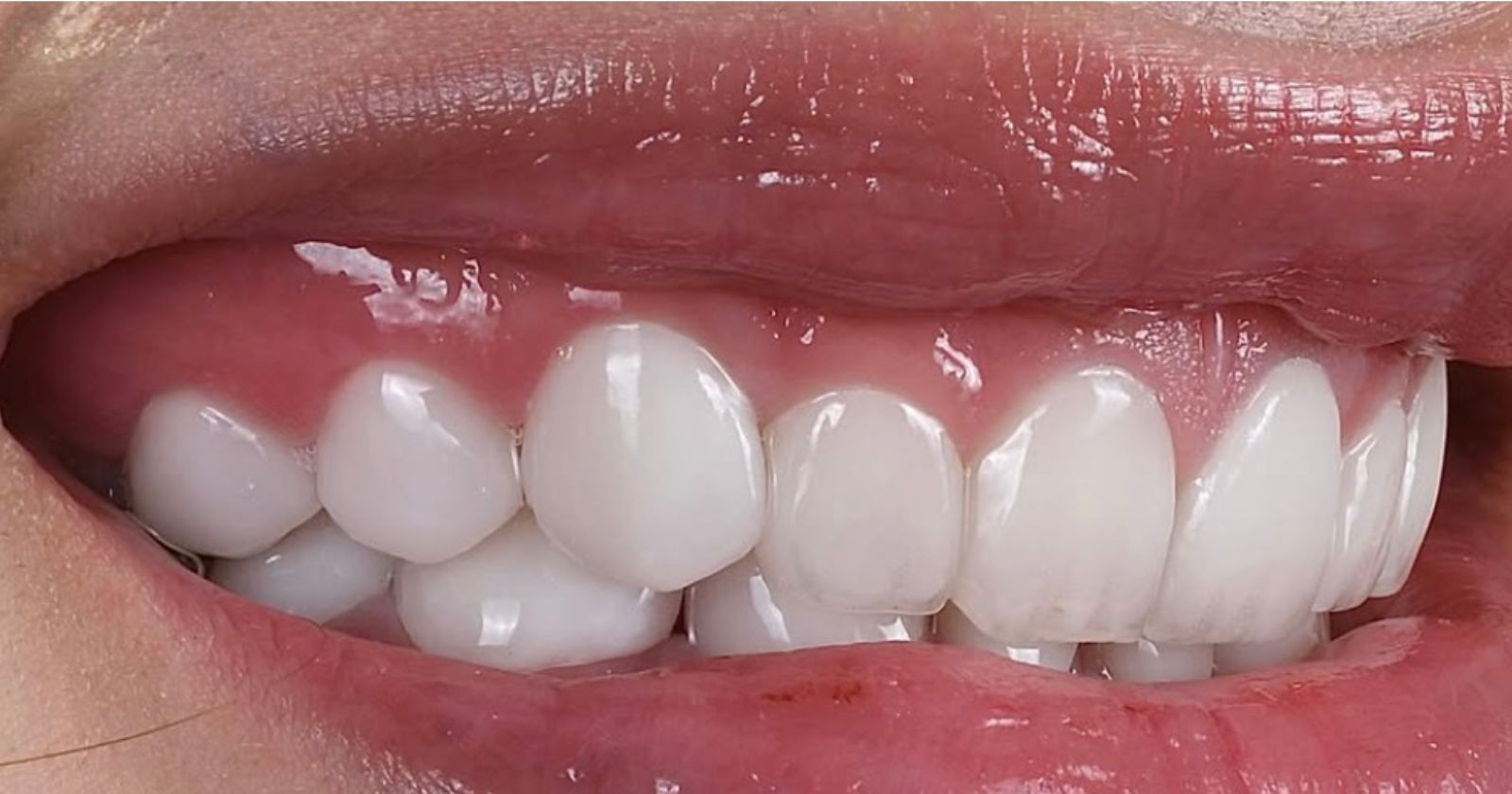 After dental implants treatment