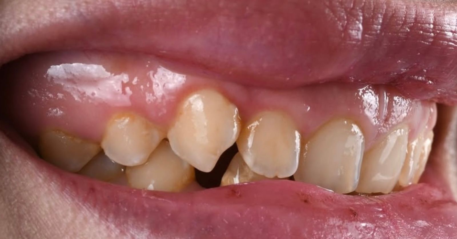Before dental implants treatment