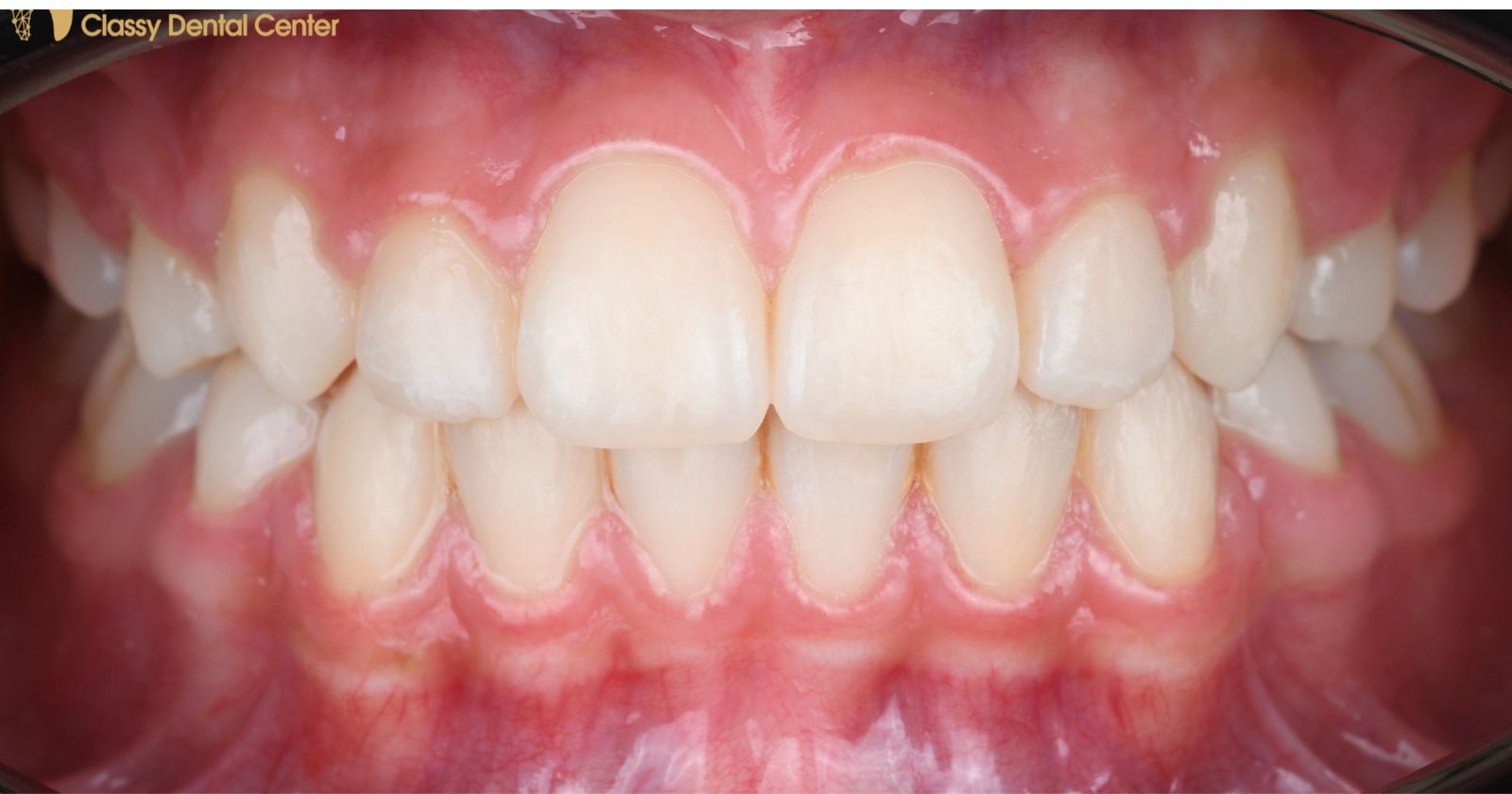 After veneers treatment