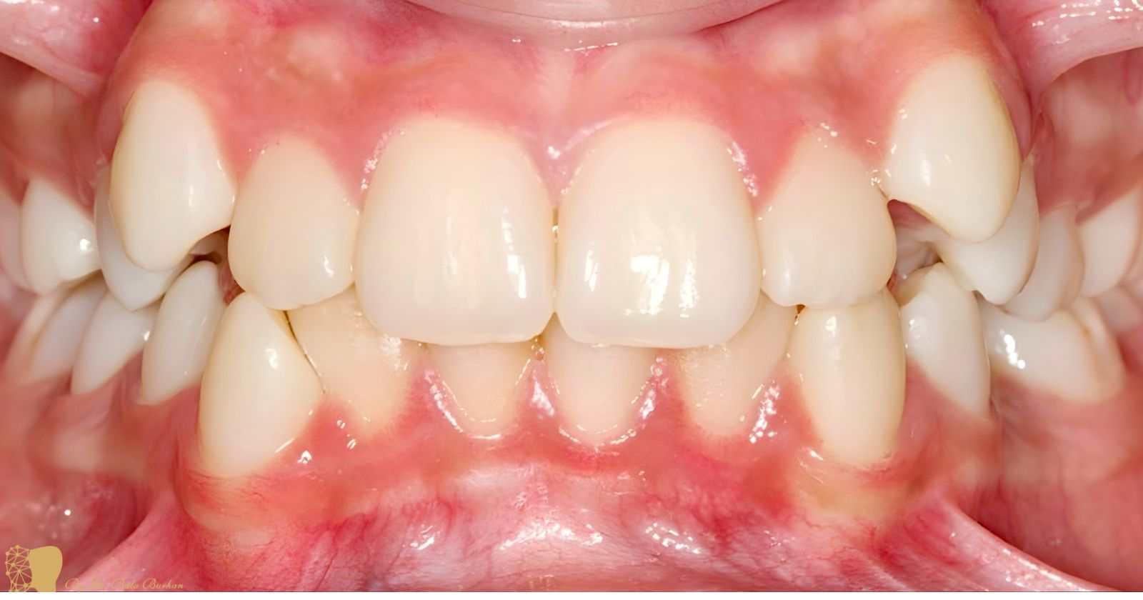 Before veneers treatment